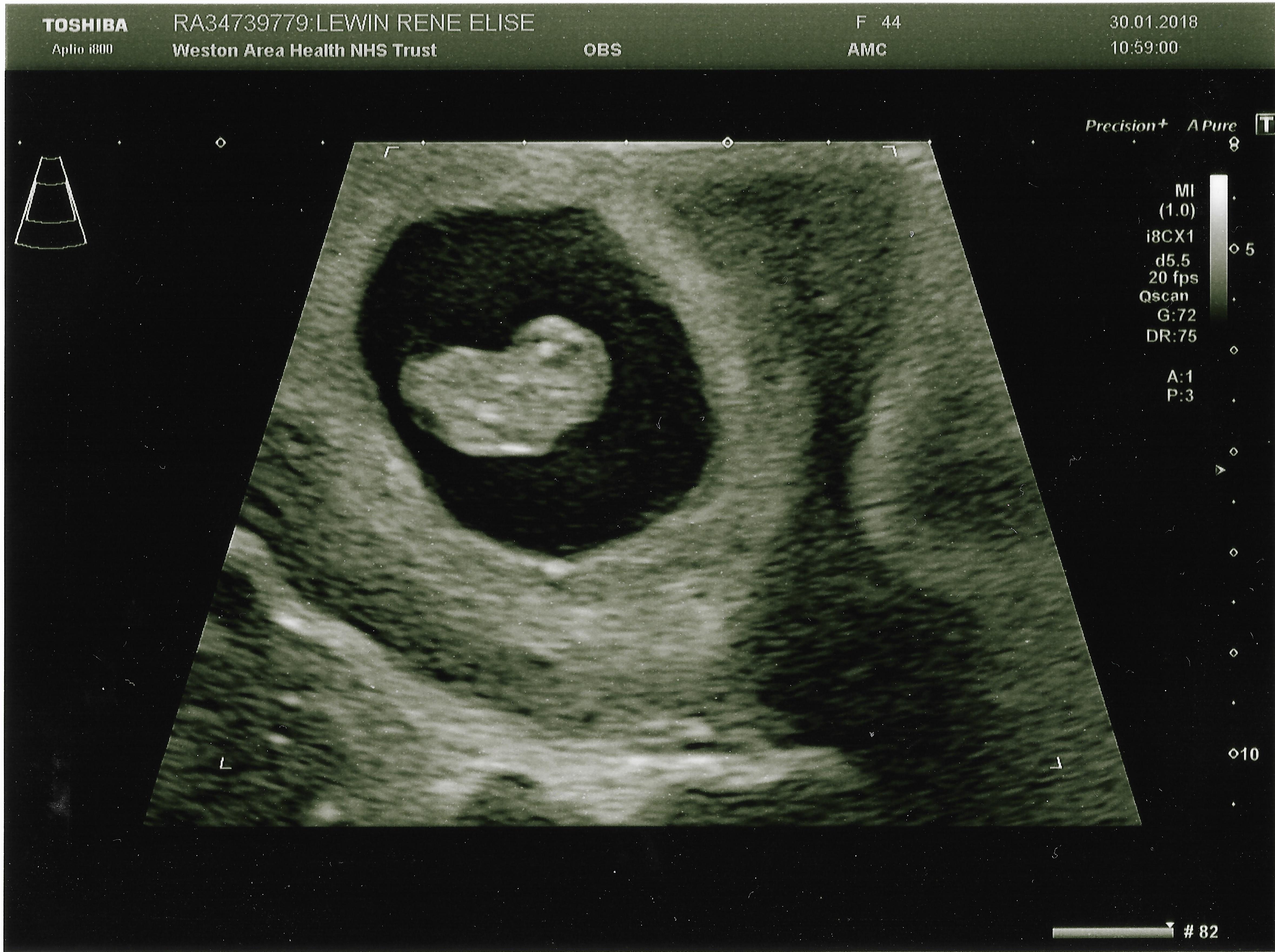 Baby 1st scan